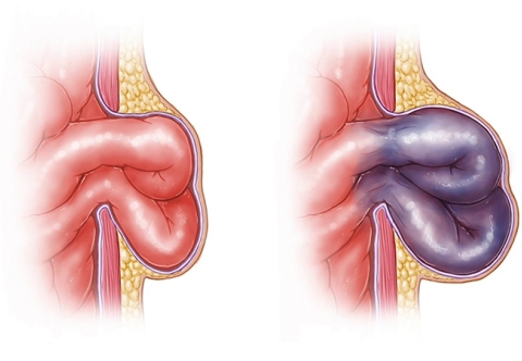 Triệu chứng nào cho thấy thoát vị bẹn có thể đang gây biến chứng nghẹt?